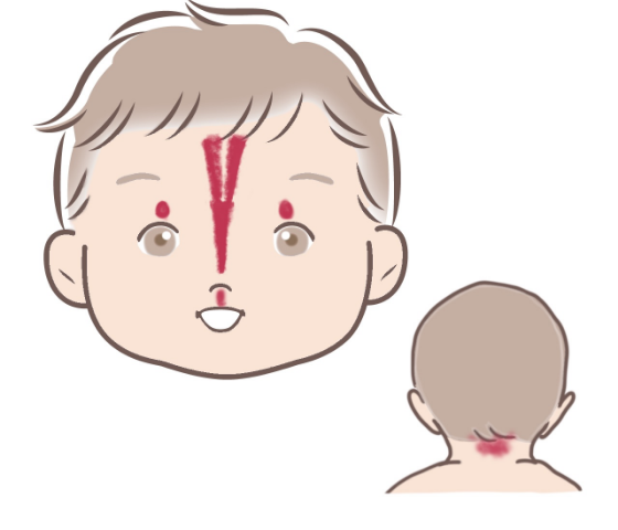 正中部母斑、サーモンパッチ（顔面）、ウンナ母斑（後頚部）のイラストです。