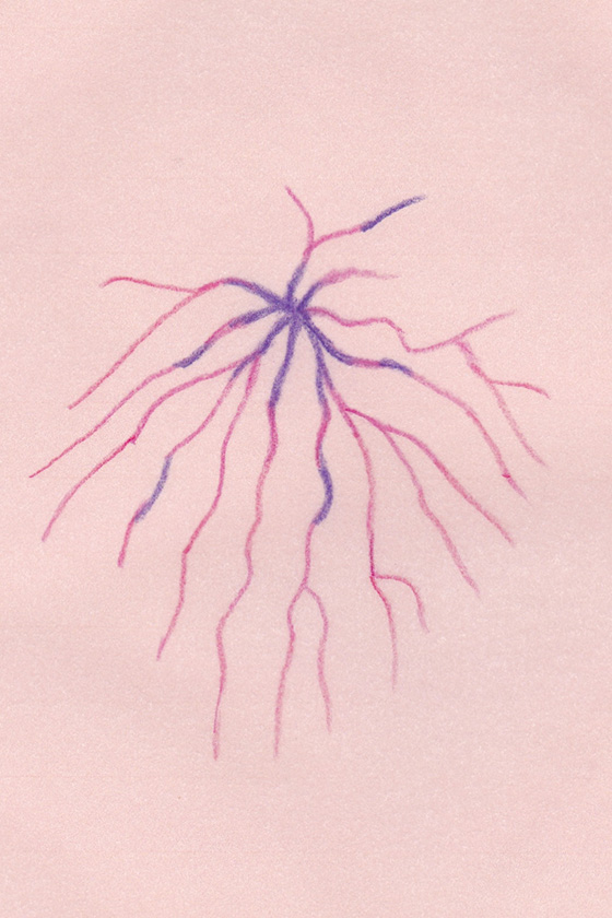 クモの巣状静脈瘤の写真です。